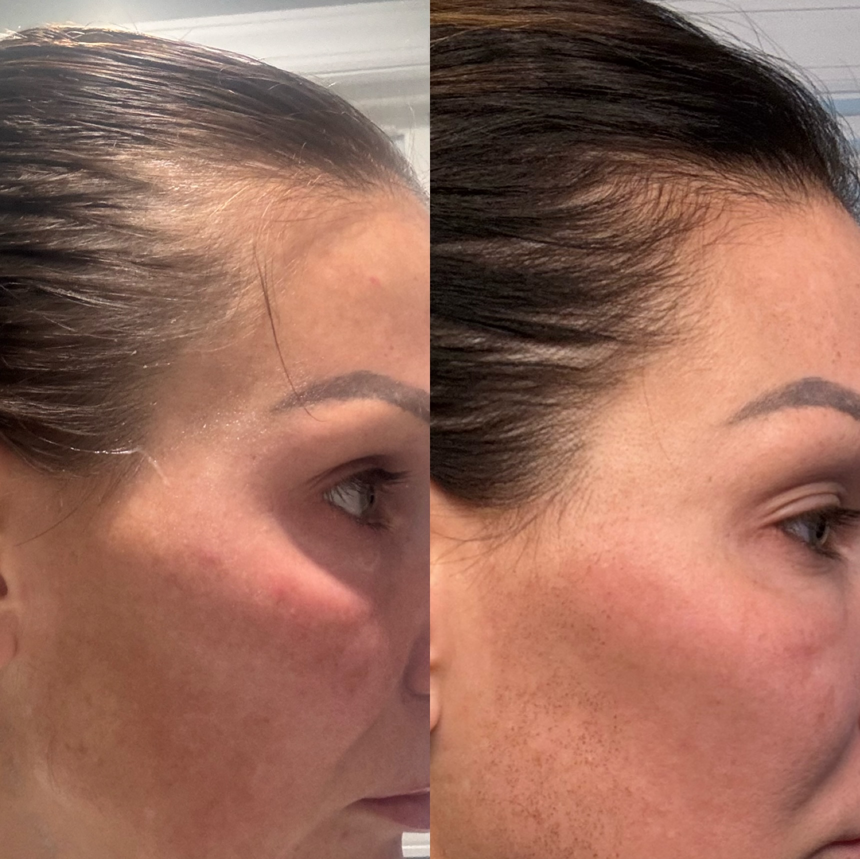 non-surgical hair restoration before and after image of a woman