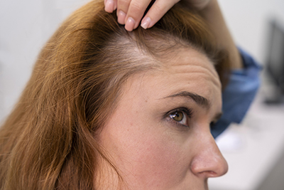 woman-thinning-hair-problem