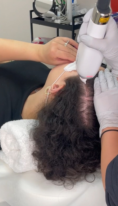non-surgical-hair-restoration-keralase-process