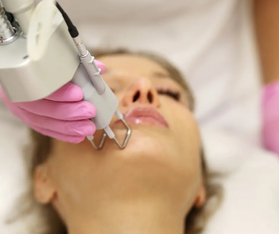 melasma laser treatment near me