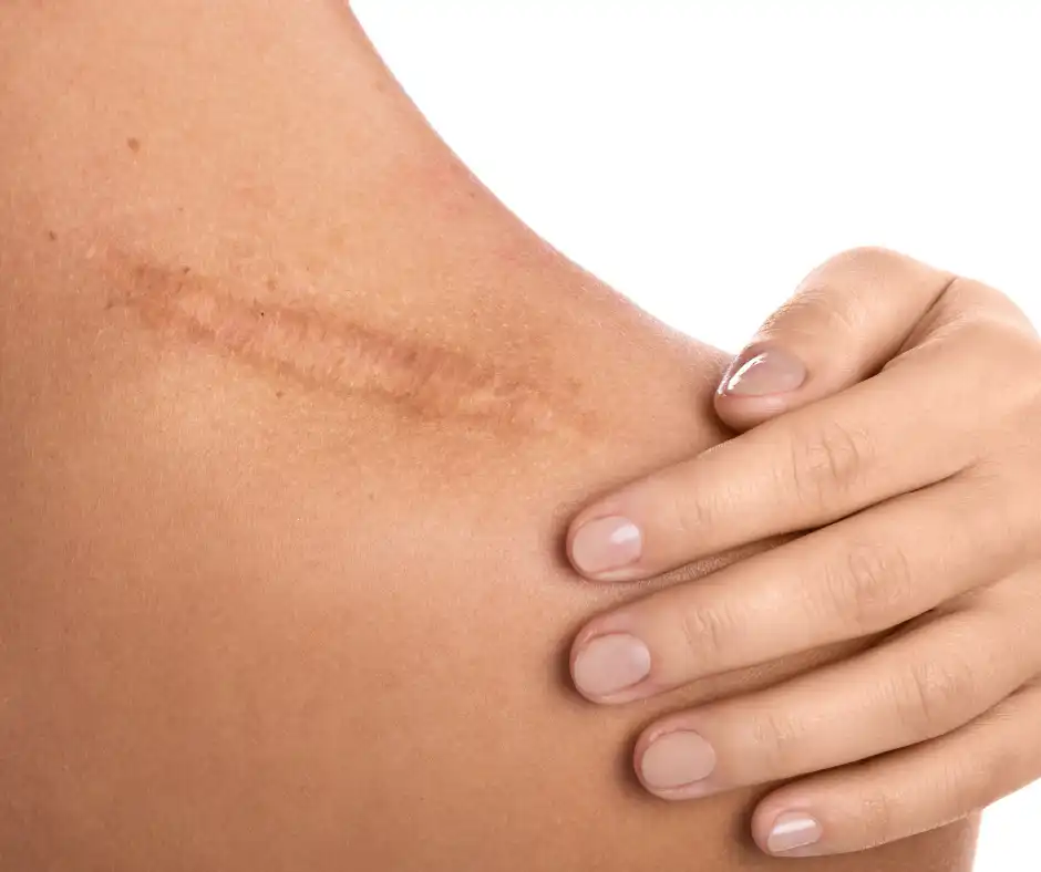 Surgical Scars Treatment Airmont, NY