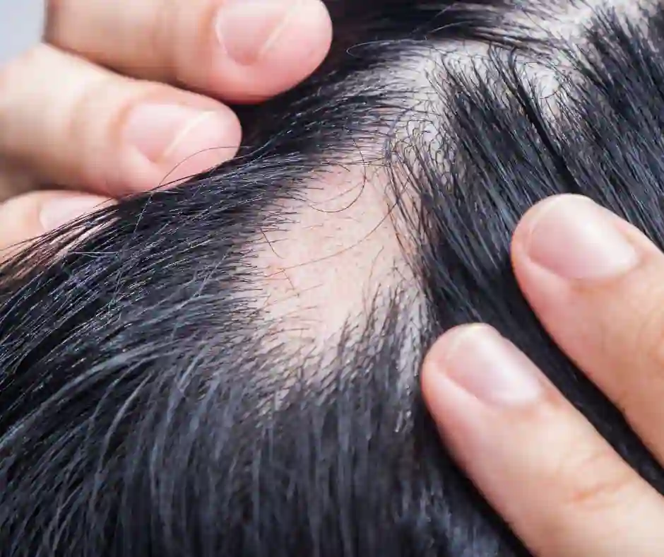 alopecia spot