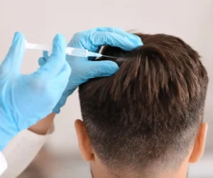 man getting alopecia treatment