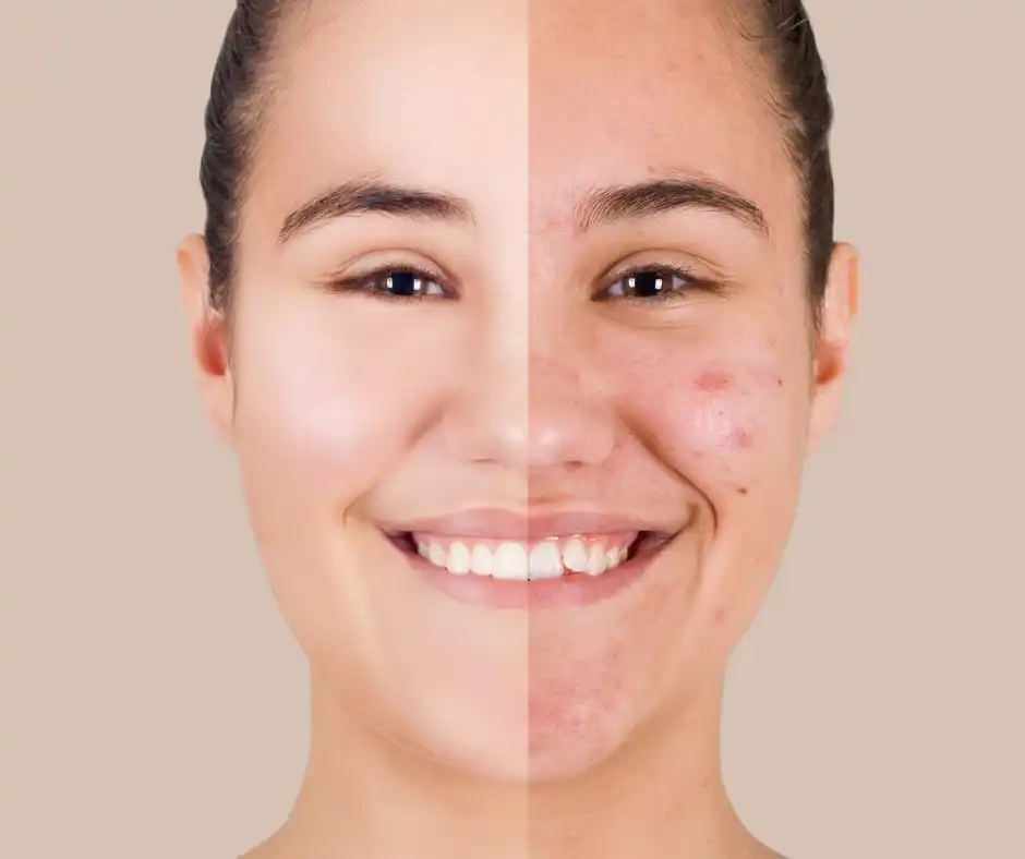 Acne Scars Treatment Airmont NY before and after