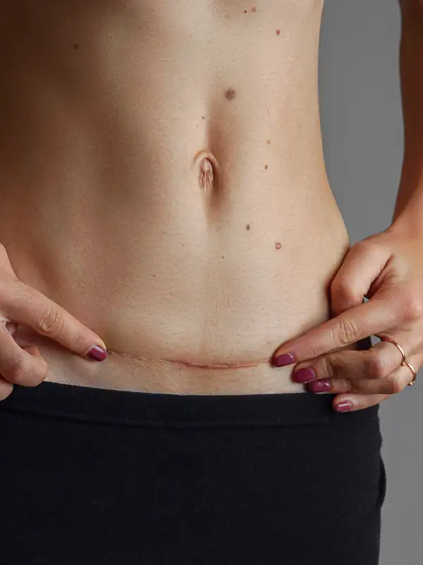 surgical scar in a woman