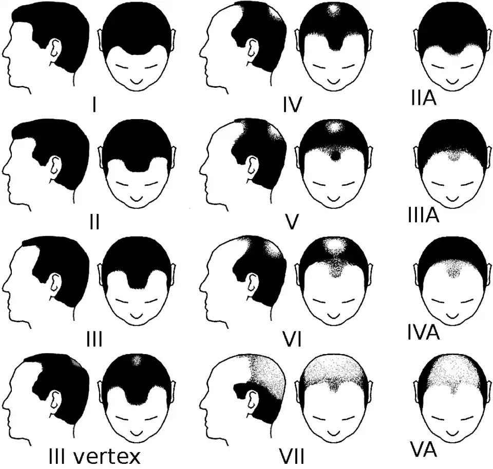norwood scale