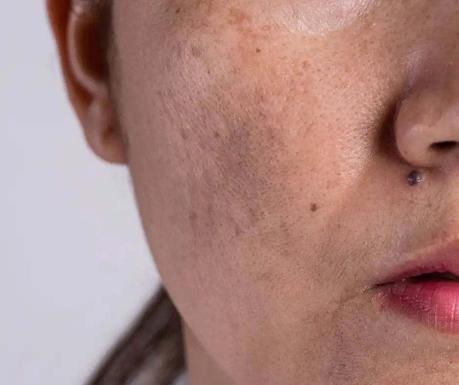 what melasma looks like - melasma treatment