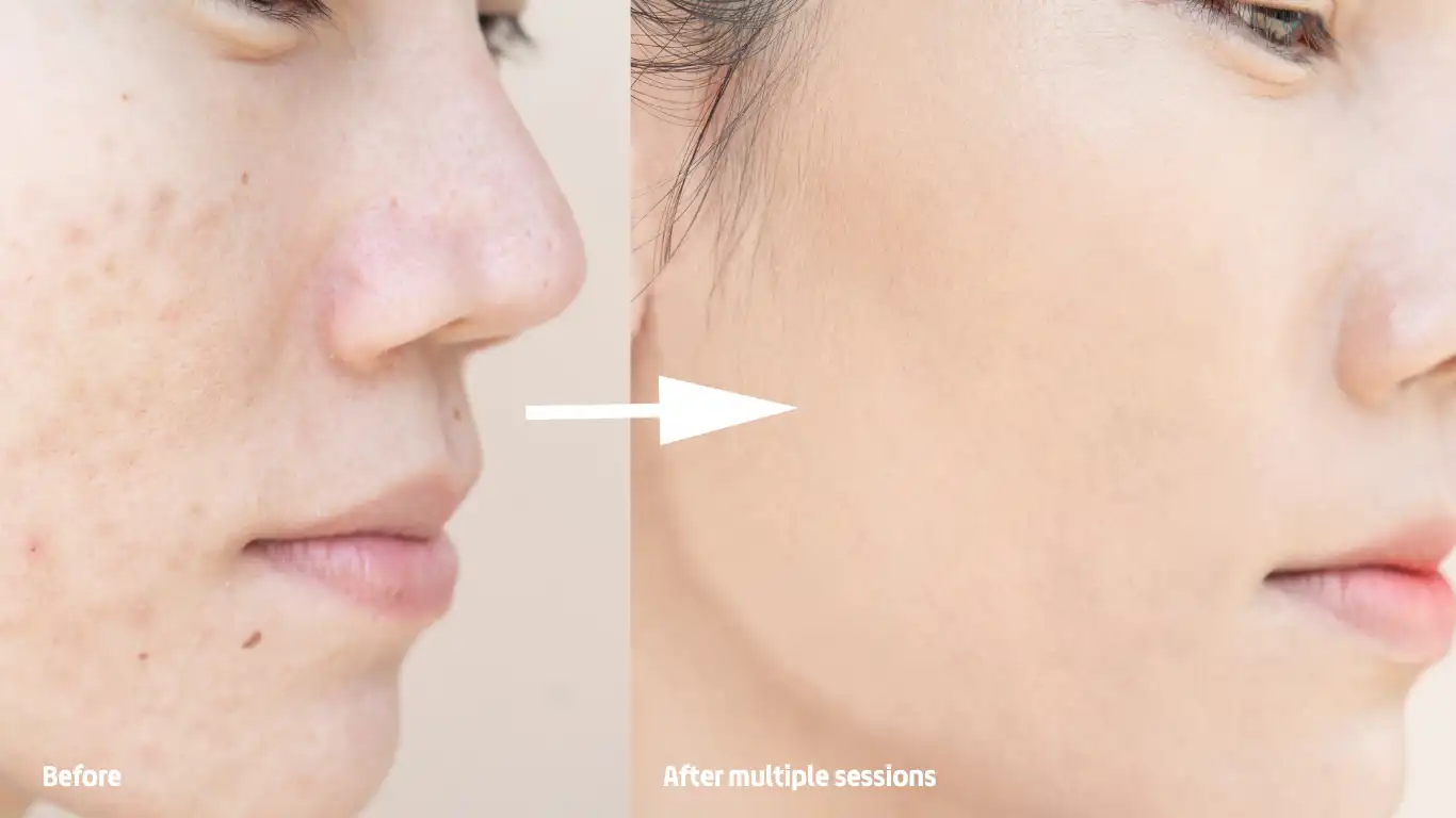 Microneedling Before and After