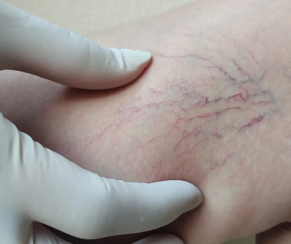 Spider Veins vs Varicose Veins