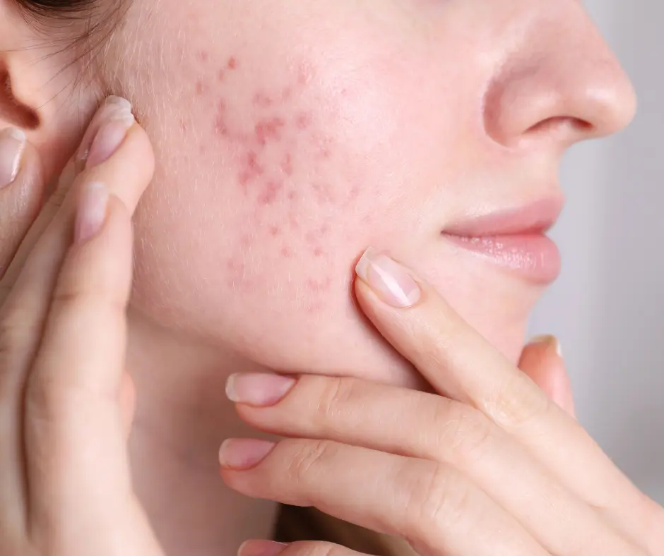 Acne scars on cheeks