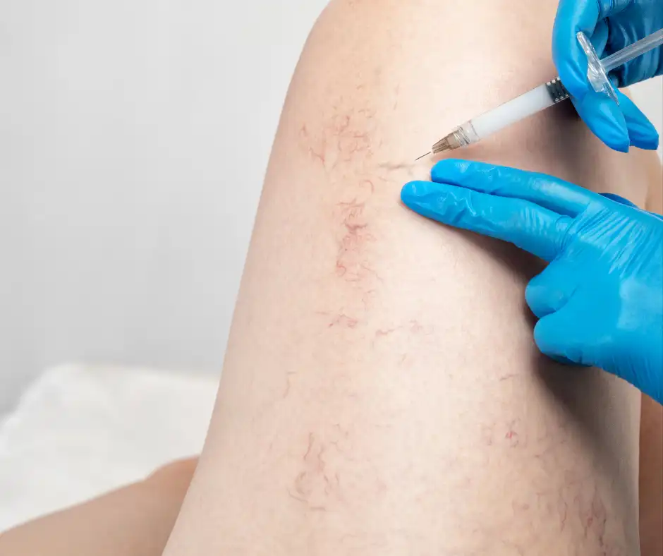 sclerotherapy for varicose veins