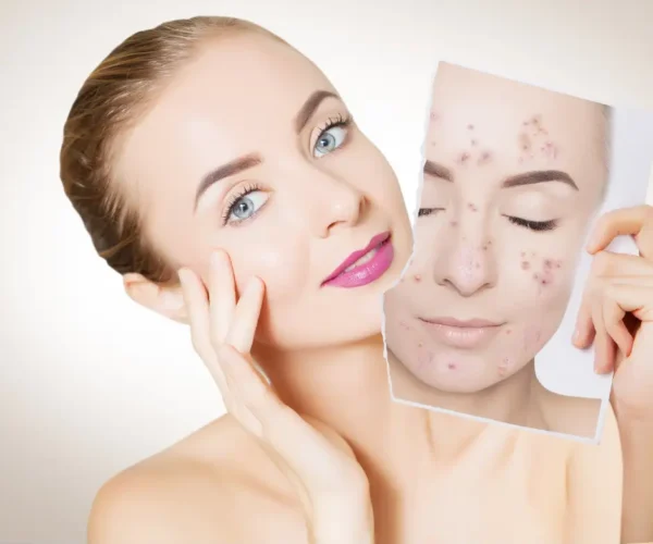 a girl with beautiful skin holding a picture of her with acne before