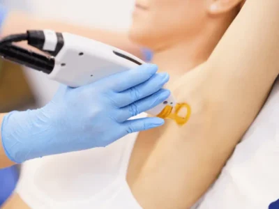 laser hair removal cost