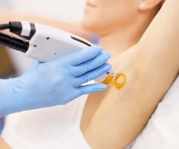 laser hair removal cost