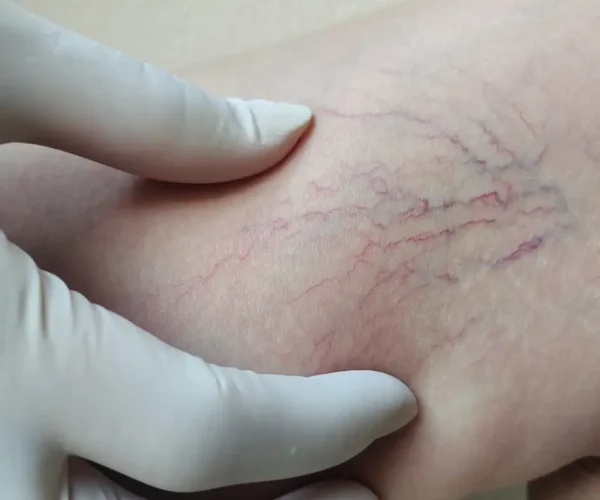 Spider Veins vs Varicose Veins