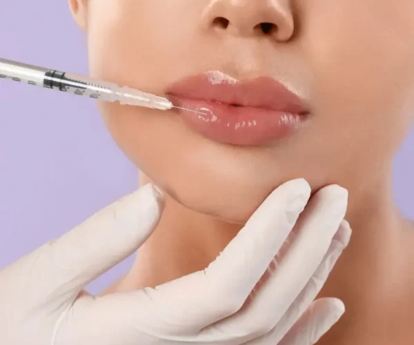 does filler dissolve - lip filler dissolver with hynidase