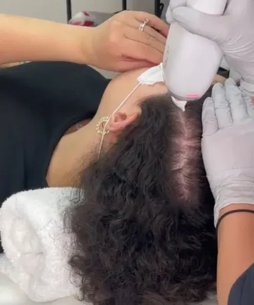 non-surgical-hair-restoration-keralase-process