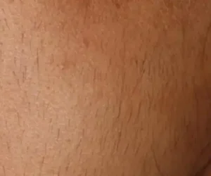 before and after result laser hair removal 4