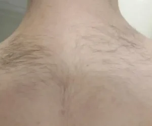 back before and after result laser hair removal lutronic clarity II