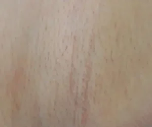 underarm before and after result laser hair removal 4