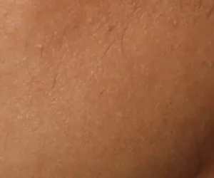 before and after result of laser hair removal using clarity II