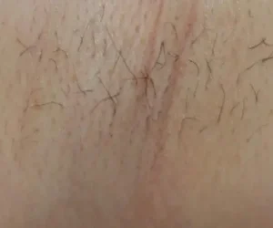 underarm before and after result laser hair removal with clarity II