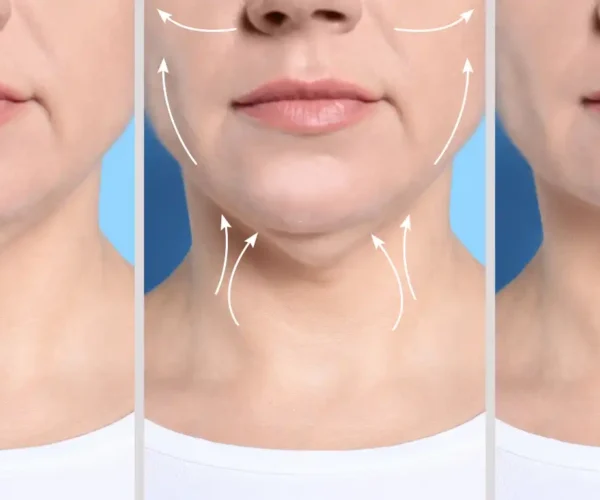 jowls in face