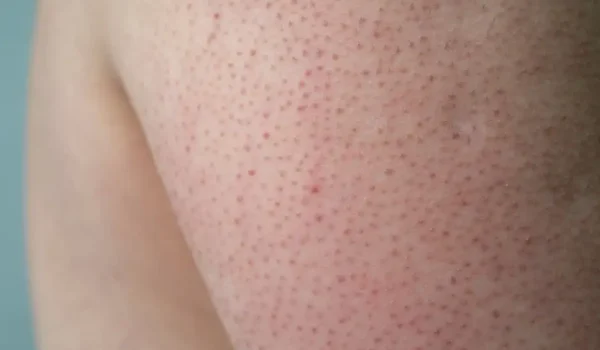keratosis pilaris skin