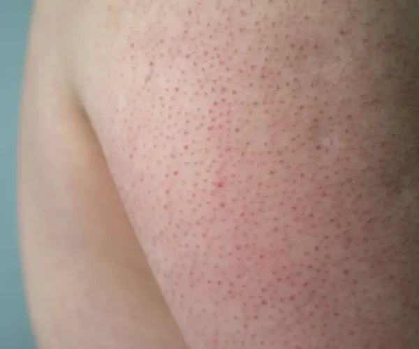 keratosis pilaris skin