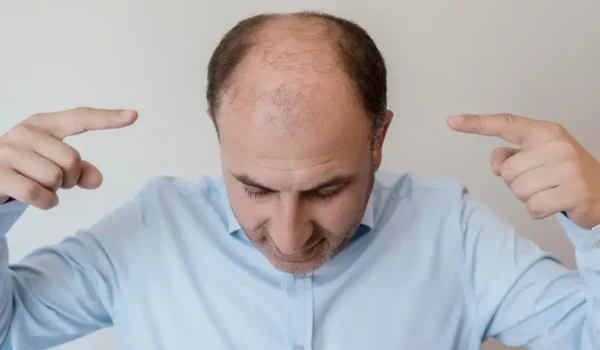 male pattern baldness