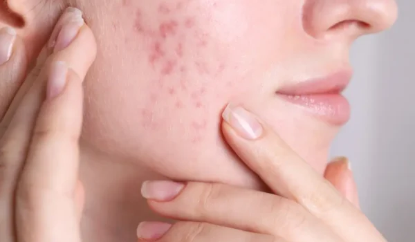 Acne scars on cheeks