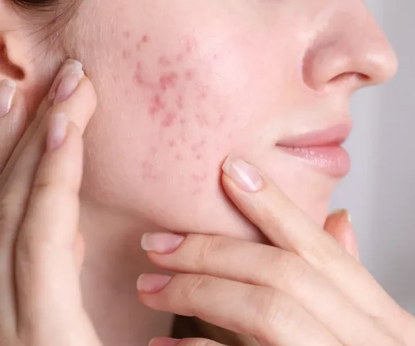 Microneedling for Acne Scars: Before and After Results Acne scars on cheeks