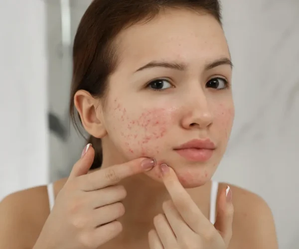 woman with acne prone skin with acne scars - treatment for acne scars