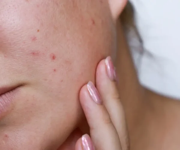 face with acne scars