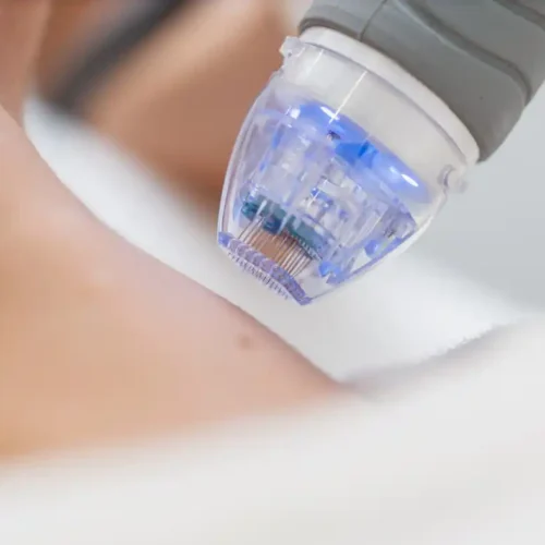 microneedling treatment for acne scars