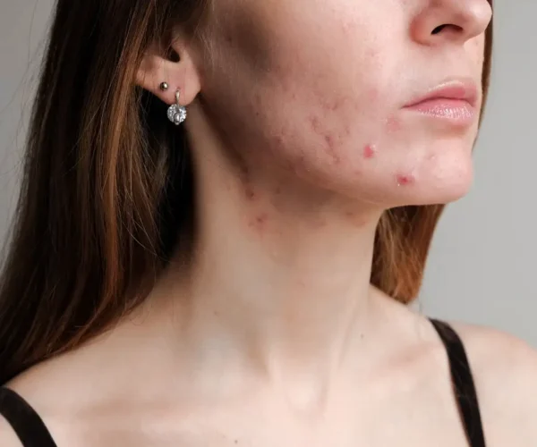 face with acne scars