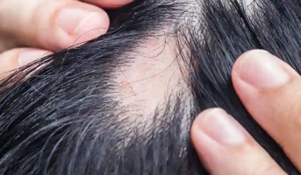 alopecia spot