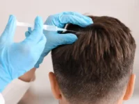 man getting alopecia treatment man getting alopecia treatment