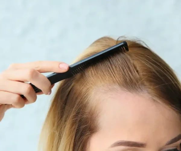 girl brushing his hair with alopecia