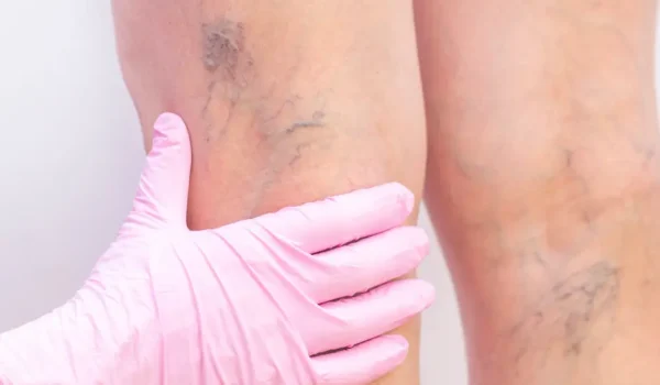 legs with spider veins