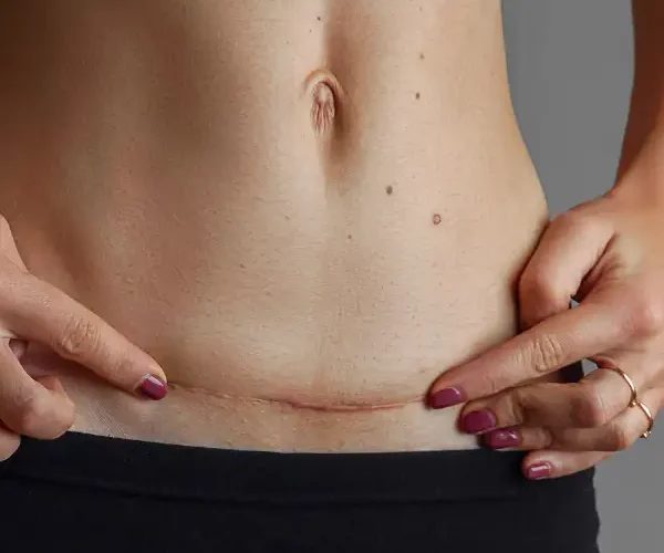 surgical scar in a woman