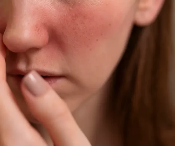 woman dealing with rosacea - treat rosacea with lutronic clarity II