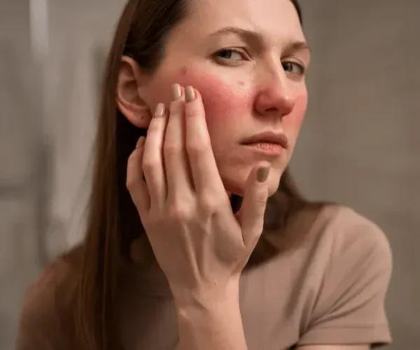 woman dealing with rosacea on her face