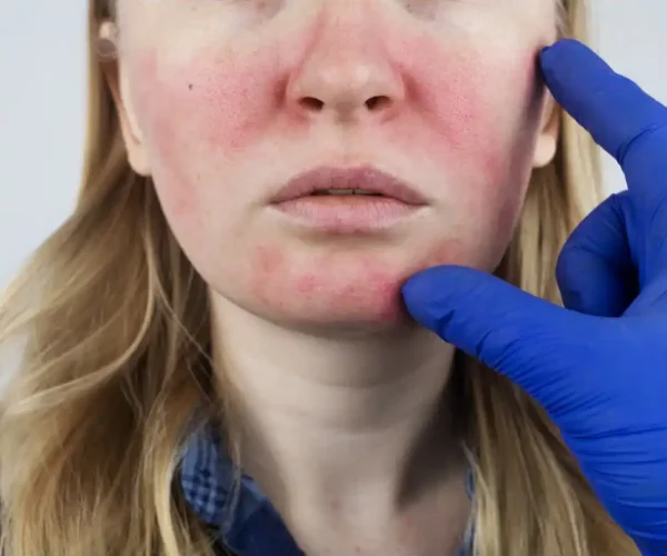 woman with facial spider veins